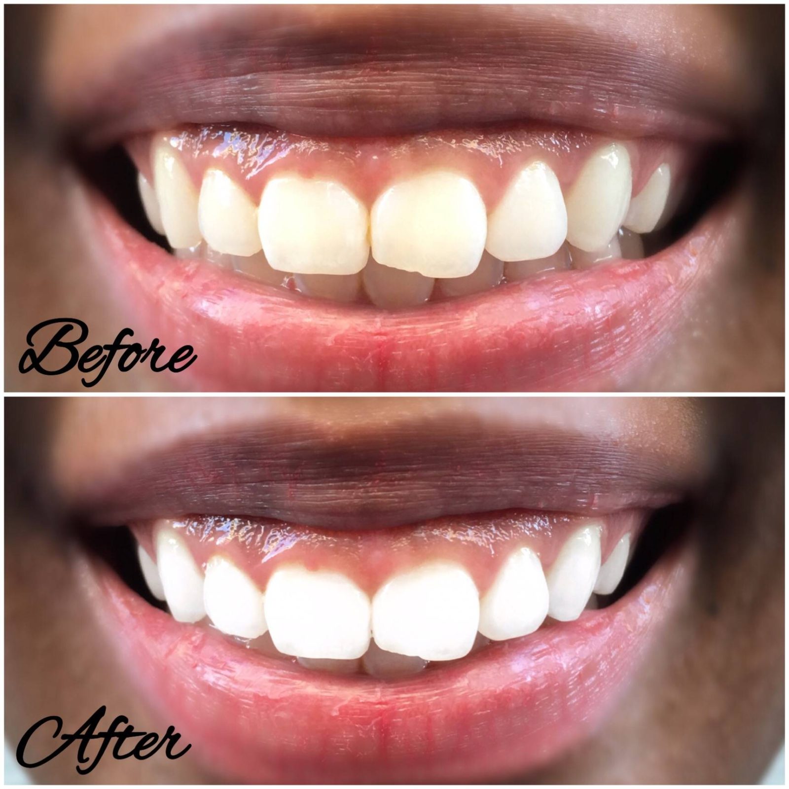 Home teeth whitening results- LeFabChic